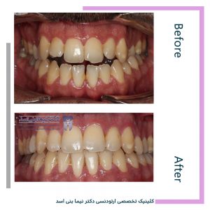 نمونه ارتودنسی ثابت شماره 102