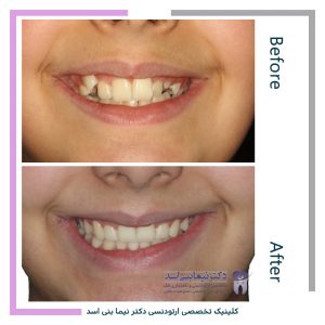 نمونه ارتودنسی ثابت شماره 103