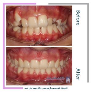 نمونه ارتودنسی ثابت شماره 103