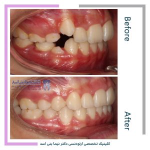نمونه ارتودنسی ثابت شماره 103
