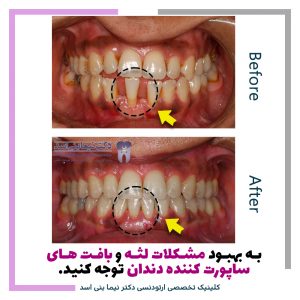 نمونه ارتودنسی ثابت شماره 104
