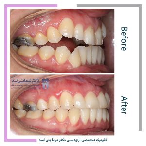 نمونه ارتودنسی ثابت شماره 105