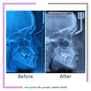نمونه ارتودنسی ثابت شماره 104
