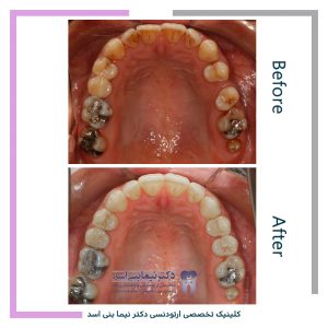 نمونه ارتودنسی ثابت شماره 104