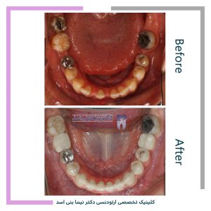 نمونه ارتودنسی ثابت شماره 104