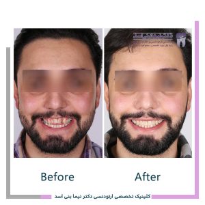 نمونه ارتودنسی ثابت شماره 118