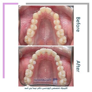 نمونه ارتودنسی ثابت شماره 119