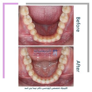 نمونه ارتودنسی ثابت شماره 119