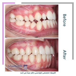 نمونه ارتودنسی ثابت شماره 119