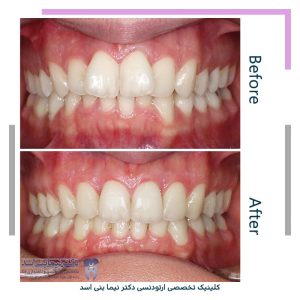 نمونه ارتودنسی ثابت شماره 120