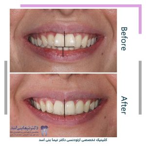 نمونه ارتودنسی ثابت شماره 120