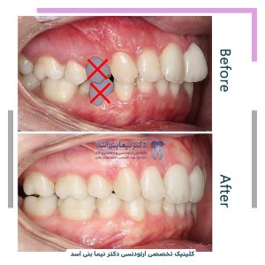 نمونه ارتودنسی ثابت شماره 120