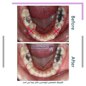 نمونه ارتودنسی ثابت شماره 120