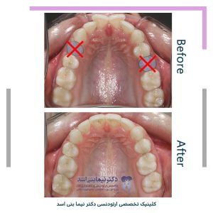 نمونه ارتودنسی ثابت شماره 120