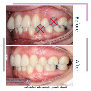 نمونه ارتودنسی ثابت شماره 120