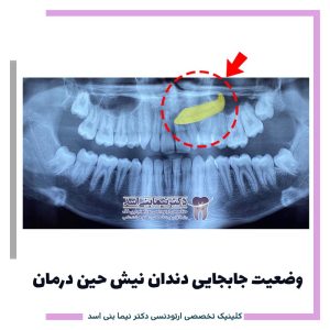 نمونه ارتودنسی ثابت شماره 121