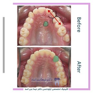 نمونه ارتودنسی ثابت شماره 121