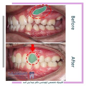 نمونه ارتودنسی ثابت شماره 121