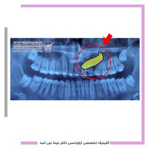 نمونه ارتودنسی ثابت شماره 121