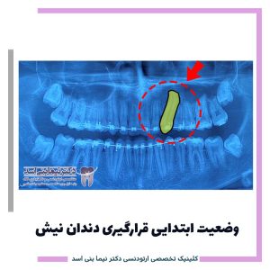 نمونه ارتودنسی ثابت شماره 121