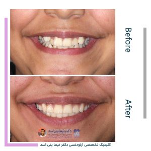‌نمونه ارتودنسی ثابت شماره 122