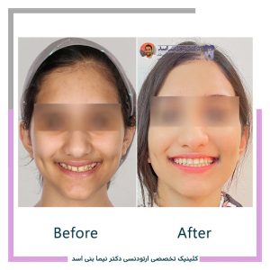 نمونه ارتودنسی ثابت شماره 123