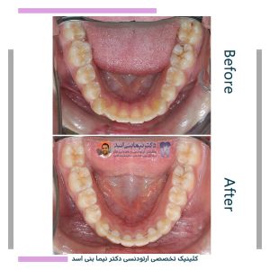 نمونه ارتودنسی ثابت شماره 124