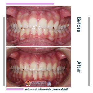 نمونه ارتودنسی ثابت شماره 124