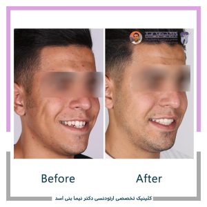 نمونه ارتودنسی ثابت شماره 125