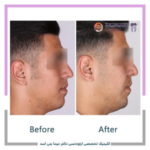 نمونه ارتودنسی ثابت شماره 125