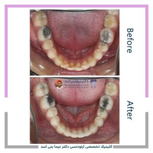 نمونه ارتودنسی ثابت شماره 125