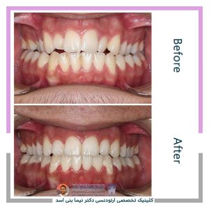 نمونه ارتودنسی ثابت شماره 125