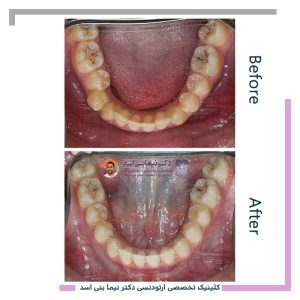 نمونه ارتودنسی ثابت شماره 126