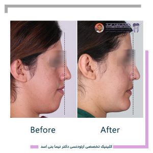 نمونه ارتودنسی ثابت شماره 126