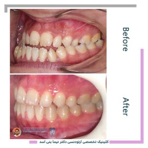 نمونه ارتودنسی ثابت شماره 126