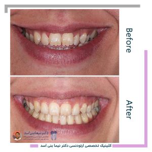 نمونه ارتودنسی ثابت شماره 126