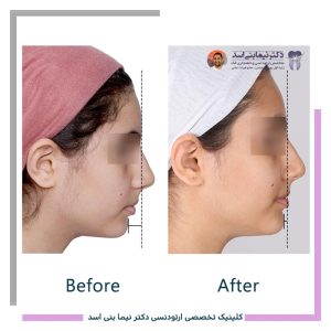 نمونه ارتودنسی ثابت شماره 127