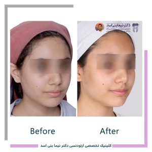 نمونه ارتودنسی ثابت شماره 127