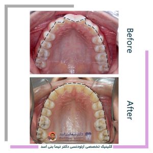 نمونه ارتودنسی ثابت شماره 127