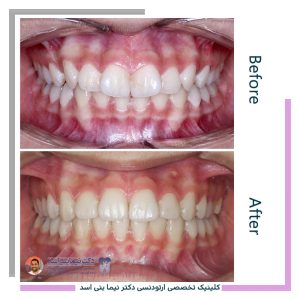 نمونه ارتودنسی ثابت شماره 127